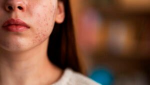 Piel-con-acne